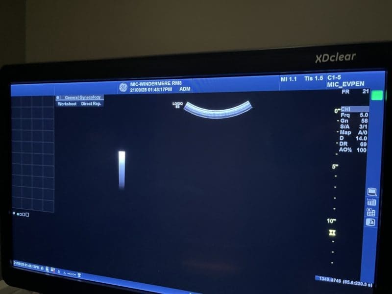My Experience With Pelvic Ultrasounds And Some Tips For Yours My Experience With Pelvic Ultrasounds And Some Tips For Yours