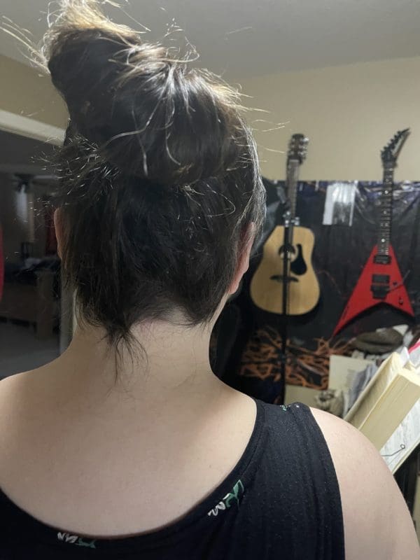 Ophiasis Alopecia Update: End Of August To Middle Of December