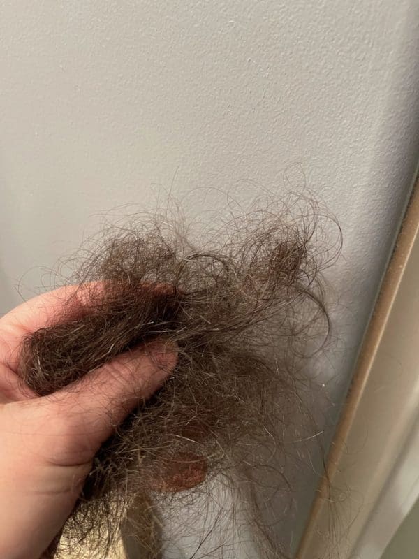 Alopecia Ophiasis: Hair Loss Again And It’s Worse This Time